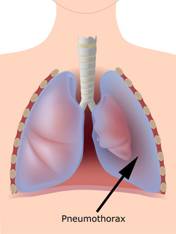 broken rib punctured lung